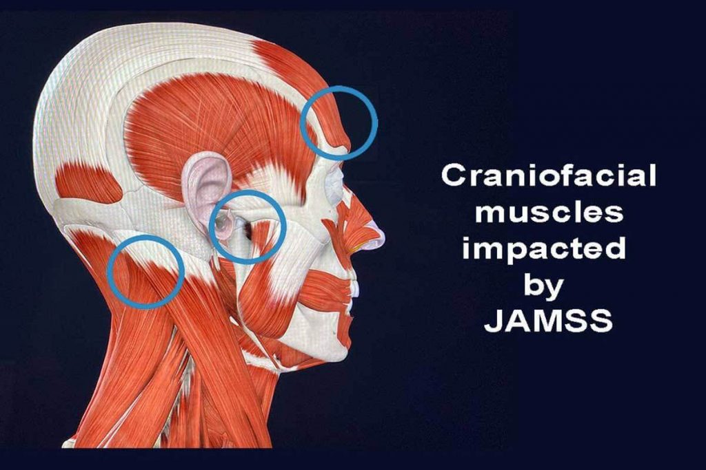 Facial and muscle groups impacted by JAMSS