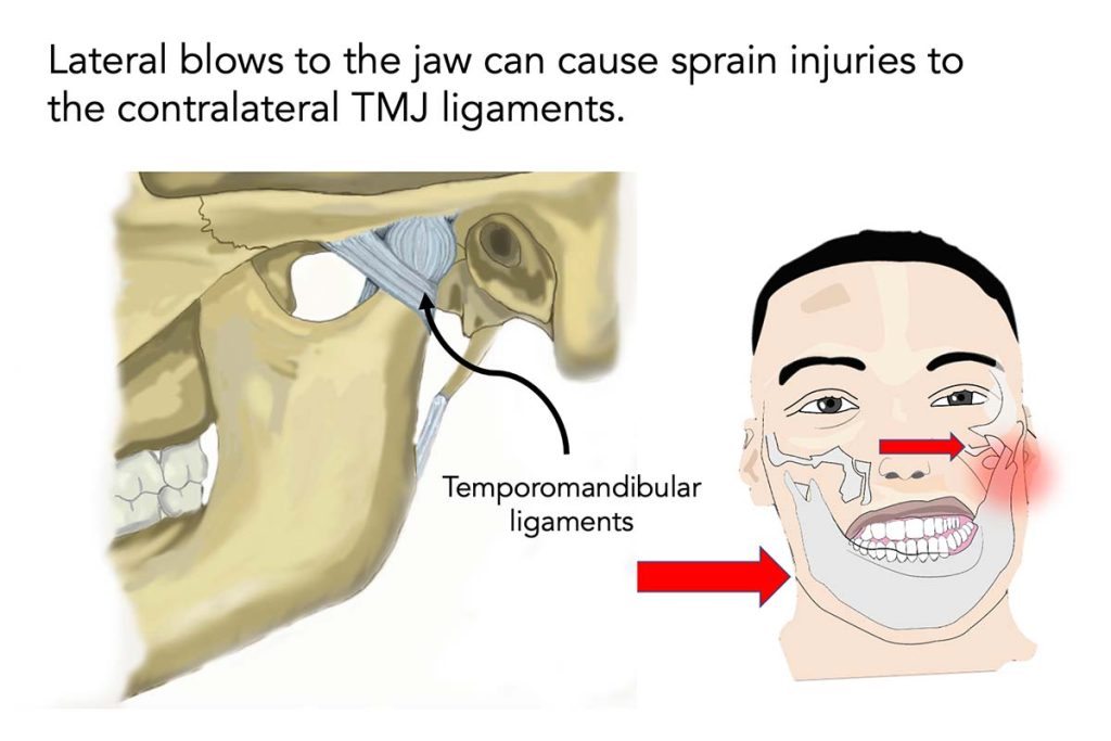 Damanged TMJ ligaments during aggressive contact sports